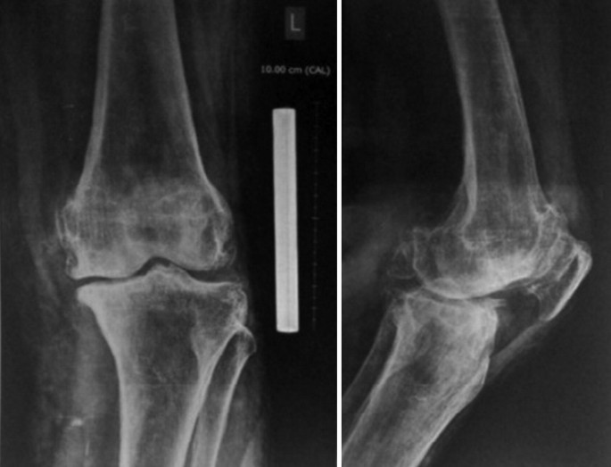 تغییر شکل واضح در استخوان یا مفصل