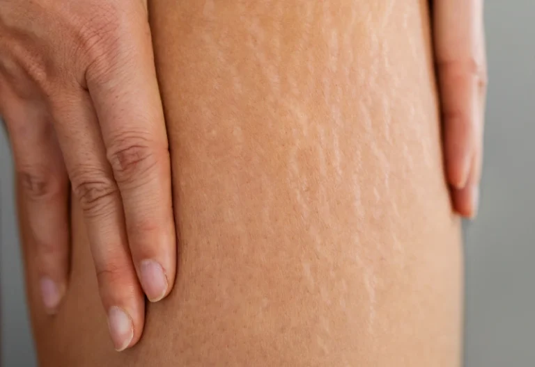 علائم سلولیت