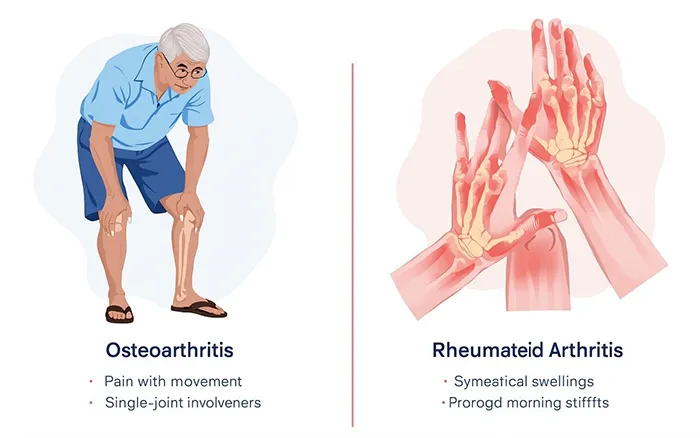 تشخیص آرتروز و آرتریت روماتوئید