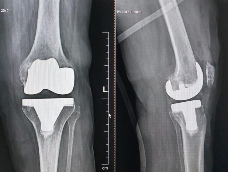 تعویض مفصل زانو به دلیل پای پرانتزی