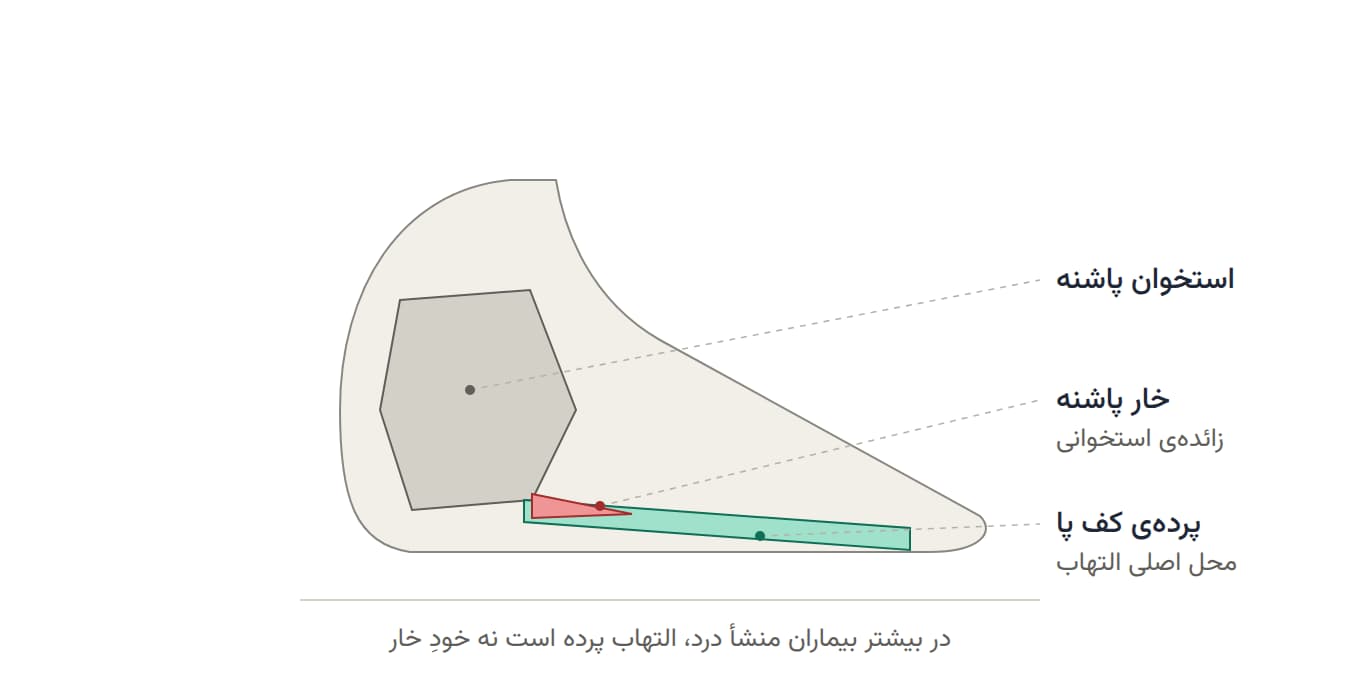 محل خار پاشنه و پرده‌ی کف پا در نمای جانبی