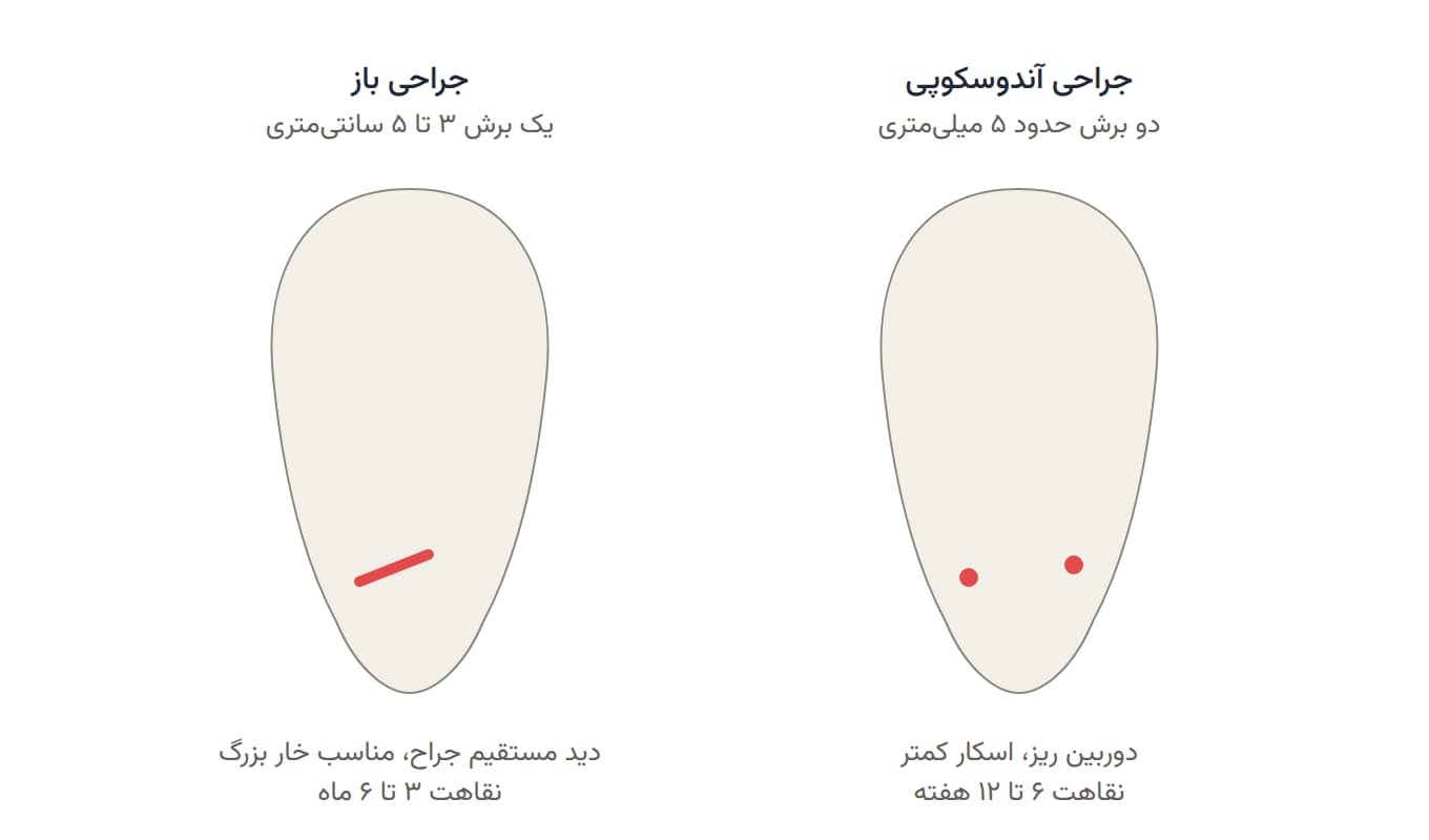 مقایسه محل برش در جراحی باز و آندوسکوپی خار پاشنه
