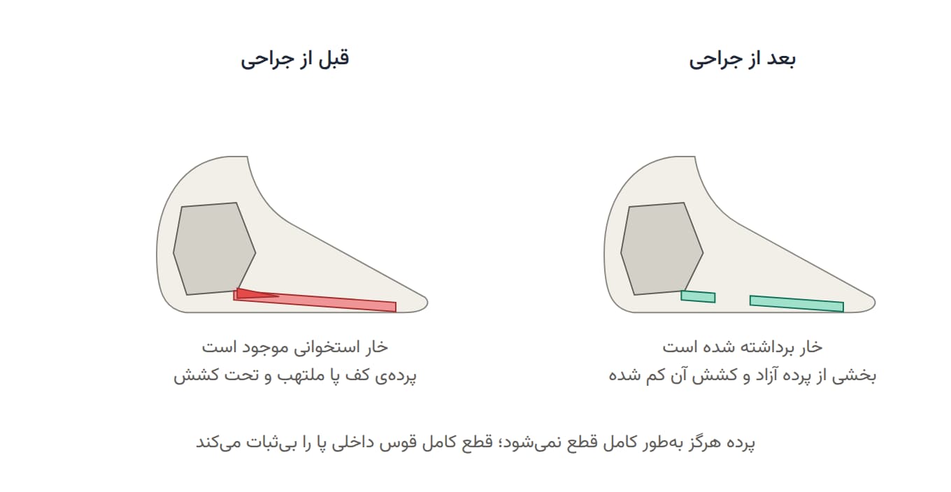وضعیت پاشنه قبل و بعد از جراحی خار پاشنه