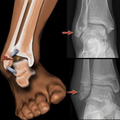 عکس شکستگی مچ پا